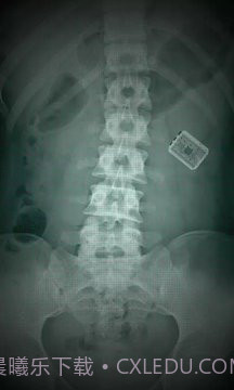 X射线扫描器胃截图3