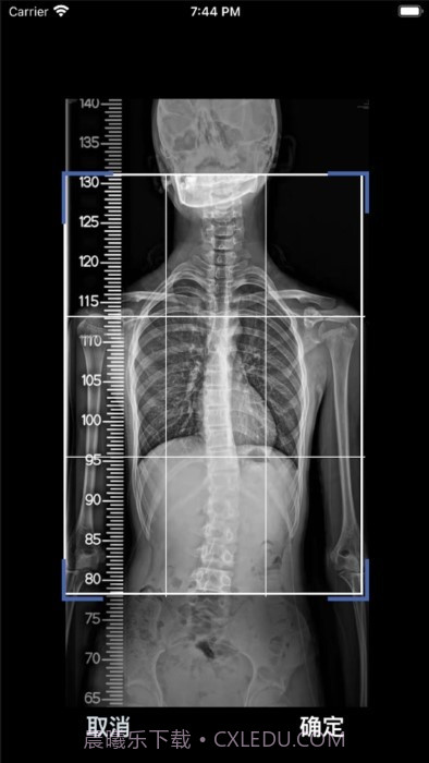 cobb角测量分析平台截图1 cobb角测量分析平台截图1